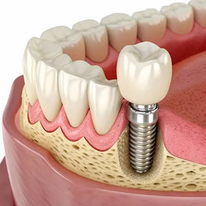 Implant Placement
