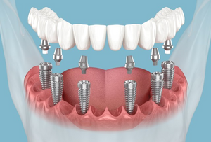 6-Implant Surgery