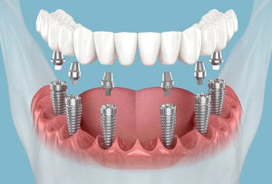 6-Implant Surgery