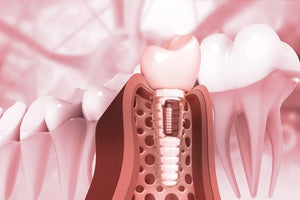 Osseointegration