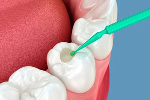 Sealants & Parent Education