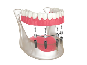 4-Implant Surgery